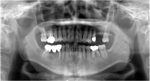 篠崎5 GBR　GBR後・メンブレン除去後2ヶ月